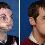 【画像】最も広範囲な顔面移植を受けた患者が順調に回復中、「人生を取り戻せた」